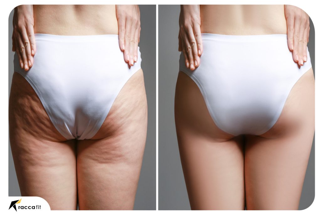 Can Glute Kickbacks Help Reduce Cellulite The Truth